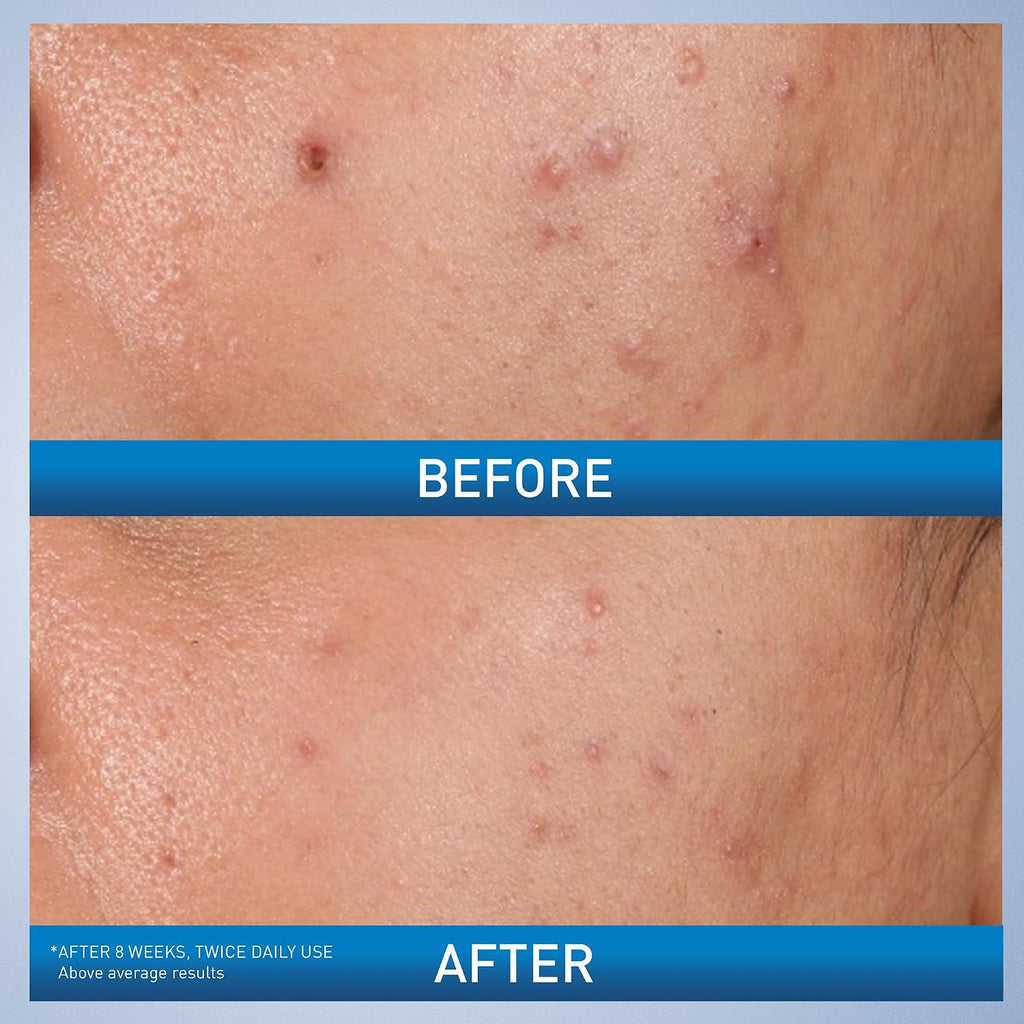 CeraVe Acne Control Gel. Salicylic & Glycolic Acid Face Treatment. 1.35oz | Niacinamide and Lactic Acid Formula Acts As A Face Exfoliator and Pore Minimizer For Face To Clear Stubborn Acne