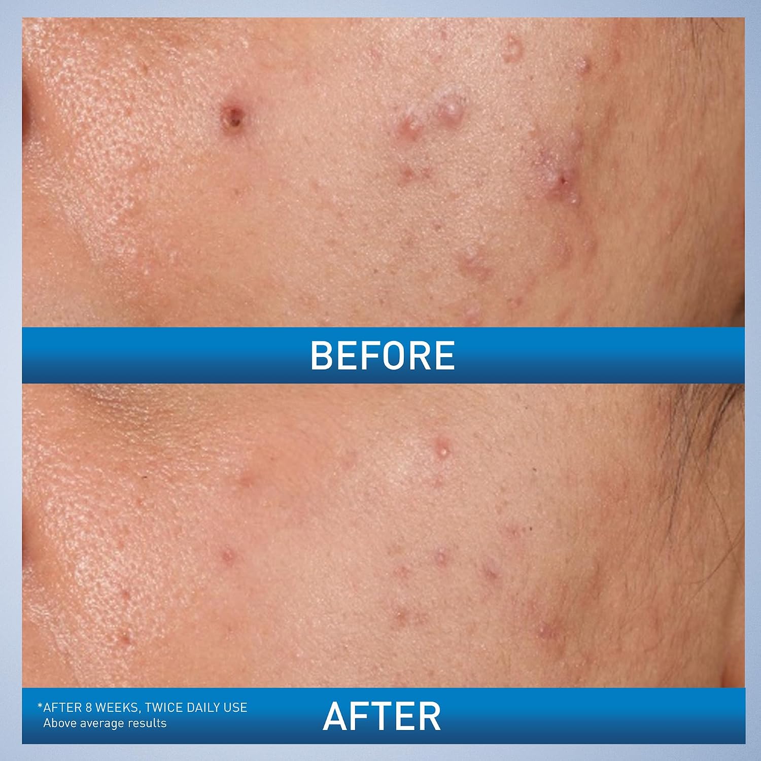 CeraVe Acne Control Gel. Salicylic & Glycolic Acid Face Treatment. 1.35oz | Niacinamide and Lactic Acid Formula Acts As A Face Exfoliator and Pore Minimizer For Face To Clear Stubborn Acne